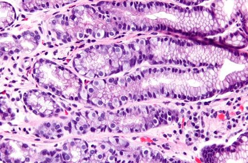 Micrographie de l'antre gastrique montrant une hyperplasie des cellules G, un changement histomorphologique observé avec l'utilisation d'un IPP (illustration @Nephron sur Wikimedia).