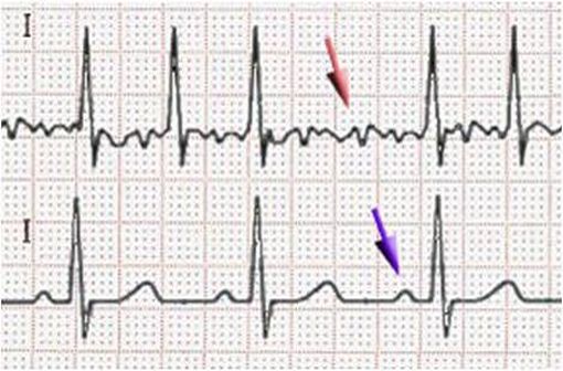 Electrocardiogramme montrant, en haut, des trémulations de la ligne iso-électrique témoins d'une fibrillation auriculaire et, en bas, un tracé normal en rythme sinusal où la flèche violette désigne l'onde P (illustration @J. Heuser sur Wikimedia).