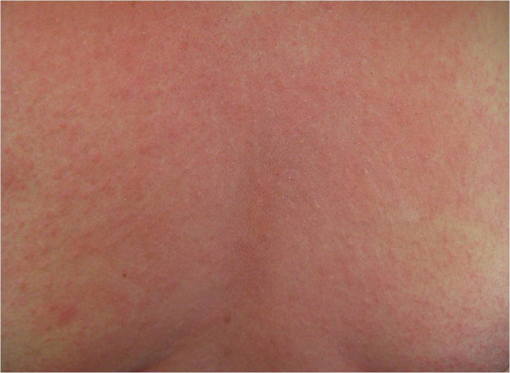 Éruption (rash) de type allergique accompagnant souvent la 1re ou 2de phase d'un choc anaphylactique (illustration @Dr James Heilman sur Wikimedia). 