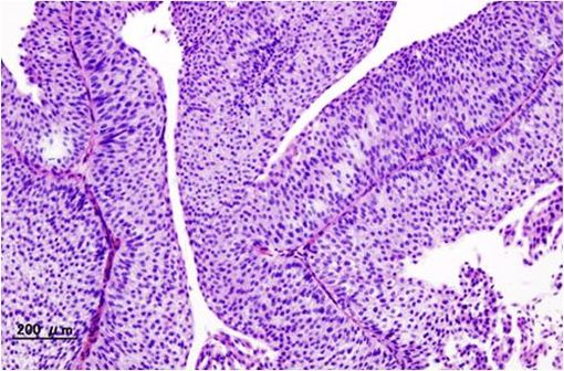 Image histo-pathologique d'un carcinome urothélial de la vessie. Biopsie transurétrale. Coloration H&E (illustration @Wikimedia).