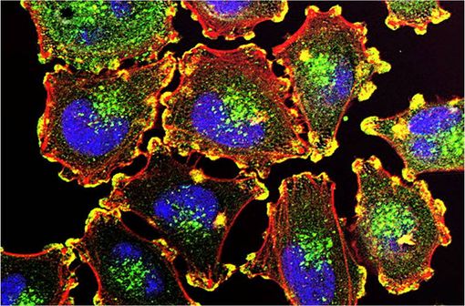 Bases moléculaires de la motilité des cellules de mélanome : podosomes riche en actine (jaune), noyaux des cellules (bleu), actine (rouge) et régulateur de l'actine (vert) [illustration @Julio C. Valencia sur Wikimedia).
