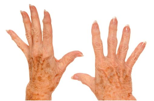 Mains d'une patiente atteinte de polyarthrite rhumatoïde (illustration).