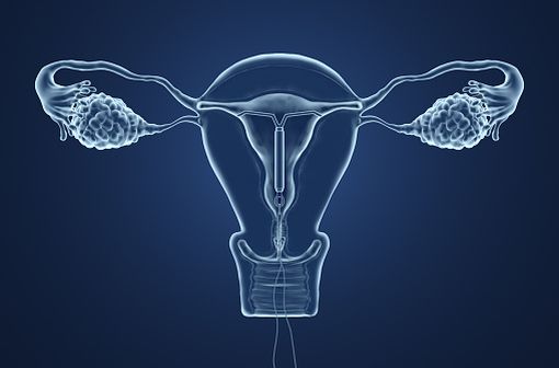 Le dispositif ou système intra-utérin, anciennement appelé stérilet, est un contraceptif inventé en 1928 par Ernst Gräfenberg (illustration).