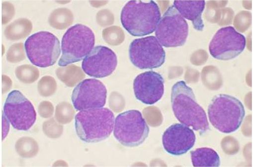 Leucémie aiguë lymphoblastique : précurseurs de cellules B sur une ponction de moelle osseuse (photo @ VashiDonsk sur Wikimedia).