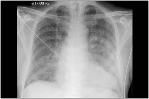 Radiographie montrant un oedème aigu pulmonaire (photo @ Dr Jeremy Jones sur Wikimedia).