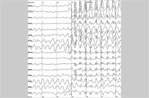 Électroencéphalogramme caractéristique de la crise épileptique (illustration @Wikimedia).