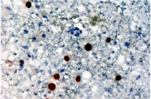 Détection immunohistochimique de la protéine du virus JC (tâches brunes) sur une biopsie cérébrale réalisée dans un contexte de LEMP (illustration @ Marvin 101 sur Wikimedia).