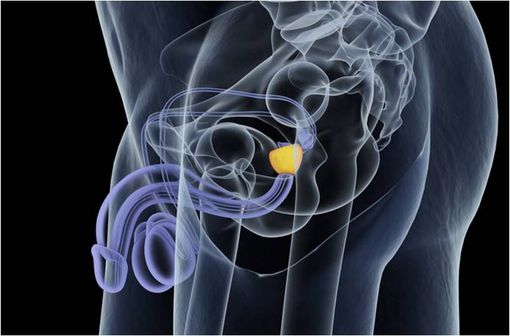 LEPTOPROL est un traitement à visée palliative indiqué chez les patients atteints de cancer avancé de la prostate hormonosensible (illustration).