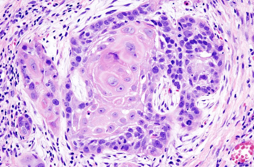 Carcinome épidermoïde invasif bien différencié (illustration @Wikimedia).