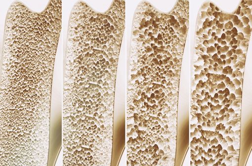 Représentation en 3D de 4 stades de l'ostéoporose (illustration).