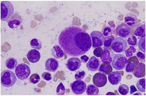 Mégacaryocyte de petite taille, hypolobé (au centre du cliché) sur une ponction de moelle, typique d'une leucémie myéloïde chronique (cliché @ Difu Wu sur Wikimedia anglais).