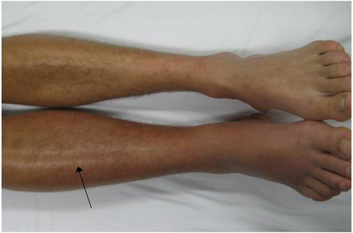 Thrombose veineuse profonde dans la jambe droite, avec rougeur et inflammation (photo @ Dr James Heilman, sur Wikimedia).