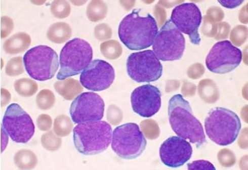 Cellules précurseurs de lymphocytes B d'une personne ayant une leucémie lymphoblastique aiguë (VashiDonsk, Wikimedia)
