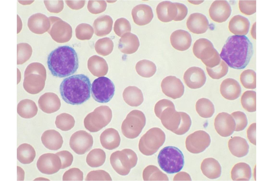 Lymphocytes B (cytoplasme bleu et noyau violet) lors d'une LLC, observés sur sang périphérique (@ Mary Ann Thompson, Wikimedia).