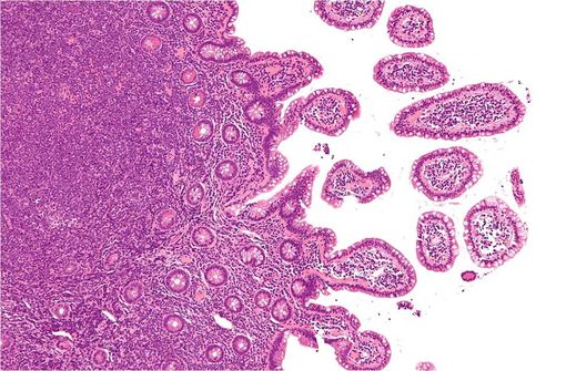 Biopsie de l'iléon terminal montrant un lymphome des cellules du manteau (cliché @ Nephron, Wikimedia)