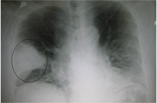Radiographie de thorax montrant une pneumonie franche lobaire aiguë en forme de coin dans le poumon droit (illustration @ Dr James Heilman, sur Wikimedia). 