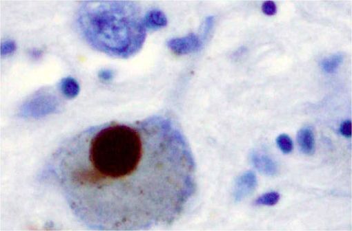 Corps de Lewy (tache brune) dans un neurone du locus niger (ou substance noire) dans la maladie de Parkinson (photo @ Marvin 101 sur Wikimedia).