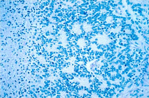 Vue microscopique d'un neuroblastome typique avec formation de rosettes (illustration @Dr Maria Tsokos, NCI sur Wikimedia).