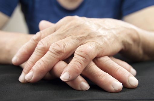 Dans la polyarthrite rhumatoïde, les articulations des mains, des poignets et des pieds sont souvent les premières touchées (illustration).
