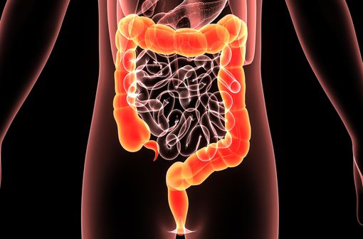La maladie de Crohn est une maladie inflammatoire intestinale chronique évoluant par poussées, alternant avec des phases de rémission, parfois incomplètes (illustration).