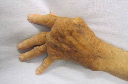 Polyarthrite rhumatoïde sévère de la main, non traitée (illustration @James Heilman, MD, sur Wikimedia).