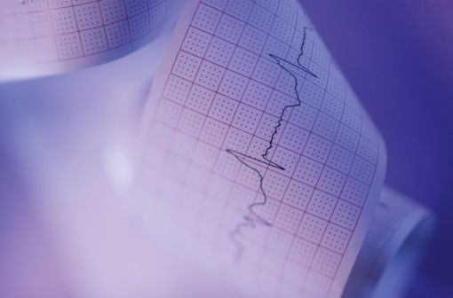 Les dystrophies myotoniques de types 1 et 2 sont associées à un risque accru de troubles du rythme ou de la conduction cardiaque (illustration.