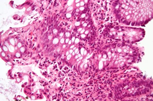 Microphotographie montrant l'inflammation du gros intestin dans un contexte de maladie inflammatoire chronique de l’intestin (illustration @Nephron sur Wikimedia).