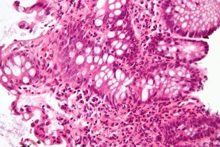 Inflammation du gros intestin sur une coupe histologique (image : © Nephron, Wikimedia) 