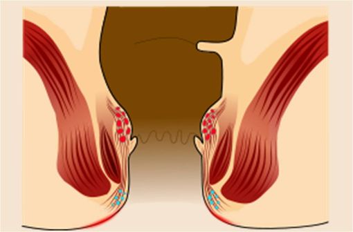 La pathologie hémorroïdaire touche les plexus veineux du canal anal, représentés ici en rouge pour les plexus internes et en bleu pour les plexus externes (illustration @Armin Kübelbeck, sur Wikimedia).