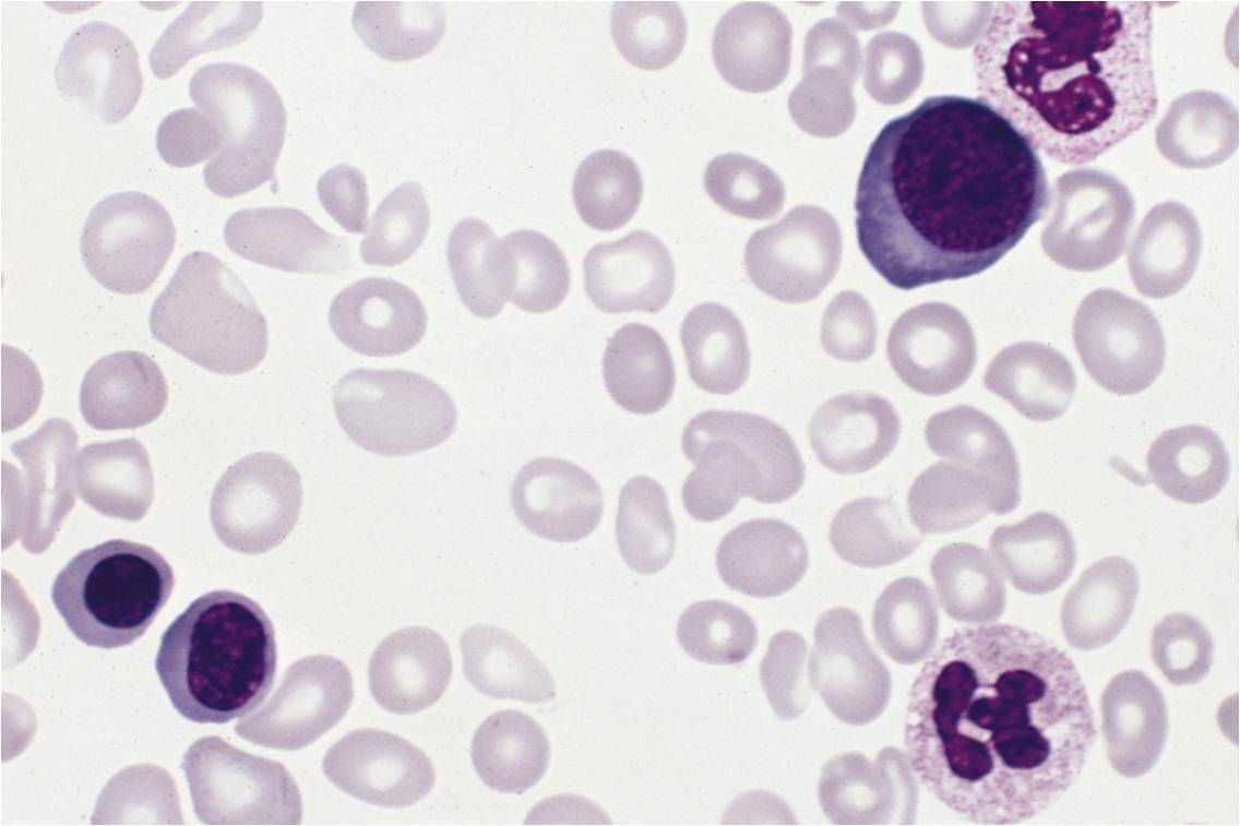 Frottis sanguin d'un patient atteint par la maladie de Vaquez (cliché @ The Armed Forces Institute of Pathology, Wikimedia)