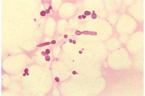 Le Pityriasis versicolor est une mycose superficielle, liée à la prolifération sur la peau d'une levure du genre Malassezia commensal : Malassezia furfur (photo @ Wikimedia). width=