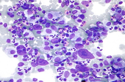 Préparation cytologique montrant un lymphome de Hodgkin (illustration @Nephron sur Wikimedia).