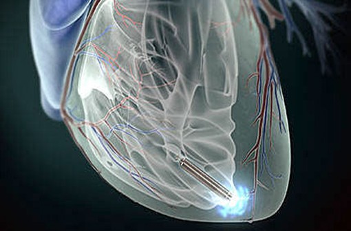 Les mini-stimulateurs sans sonde sont placés directement dans le ventricule droit