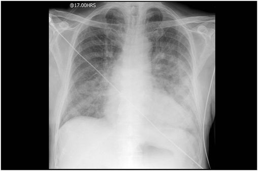 Radiographie d'un oedème aigu du poumon (cliché @ Frank Gaillard et Jeremy Jones sur Wikimedia).