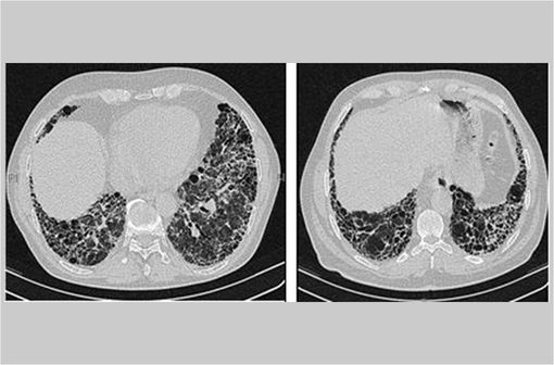 Tomodensitométrie haute résolution des poumons d’un patient atteint de fibrose pulmonaire idiopathique (illustration @IPFeditor, sur Wikimedia).