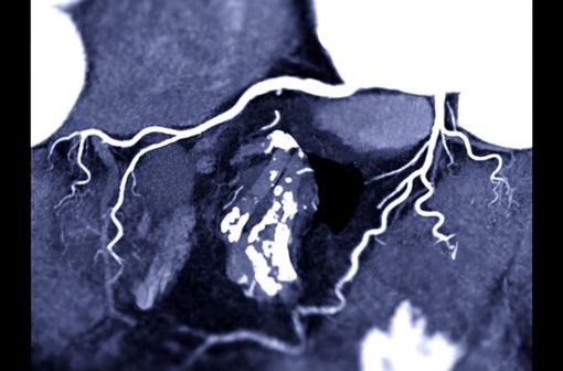 Artériographie coronaire avec produit de contraste iodé (illustration).