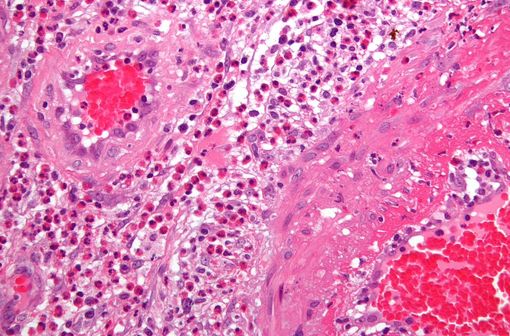 La maladie de Behçet est une vascularite systémique qui se manifeste le plus souvent par des symptômes cutanéo-muqueux (aphtose), articulaires (douleur) et ophtalmiques (uvéite) [illustration@Nephron sur Wikimedia].