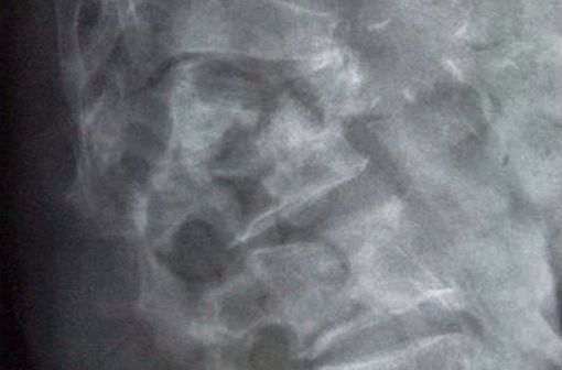 Fractures vertébrales multiples dues à l'ostéoporose (clichés radiographiques @ Glitzy queen00 - Wikimedia).