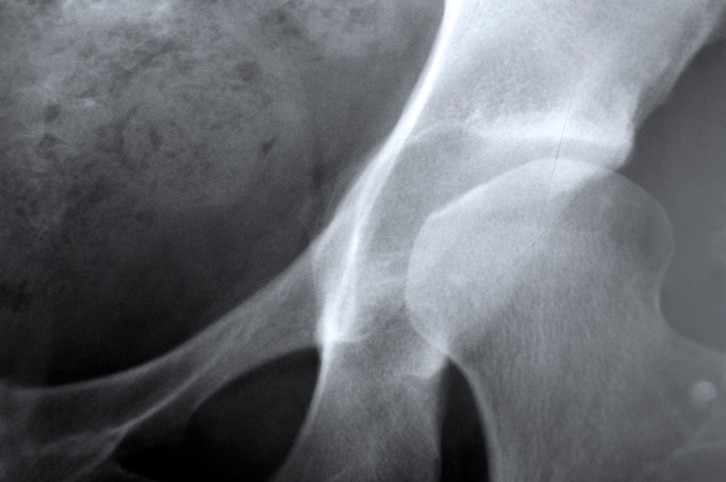 Ostéoporose de hanche post-ménopausique (radiographie)