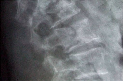 Ostéoporose (illustration : fracture vertébrale en L1-L2 - Cliché radiographique @ Wikimedia).