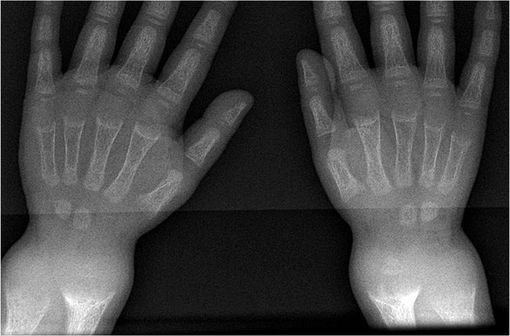 Radiographie du poignet montrant des lésions de rachitisme, principalement ici des ventouses (illustration @Frank Gaillard sur Wikimedia).