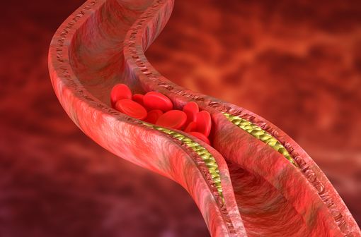 Représentation en 3D d'une plaque de cholestérol dans les parois d'une artère (illustration).