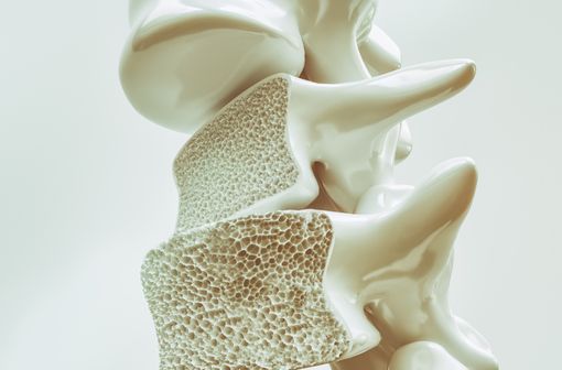 <p>Représentation en 3D de lésions d'ostéoporose localisées aux vertèbres (illustration).</p>