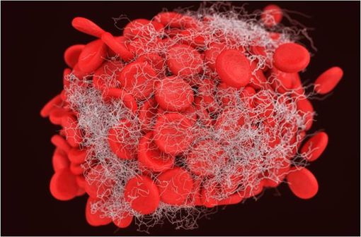Représentation en 3D d'un caillot sanguin (illustration).