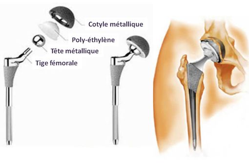  Exemple de composition d'une prothèse totale de hanche (© ANSM).