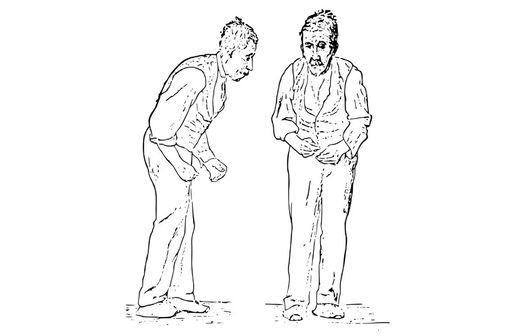 Illustration de l'attitude générale d'un patient atteint de la maladie de Parkinson par Sir William Richard Gowers, médecin neurologue et pédiatre britannique (1845-1915) [illustration @ Wikimedia]. 