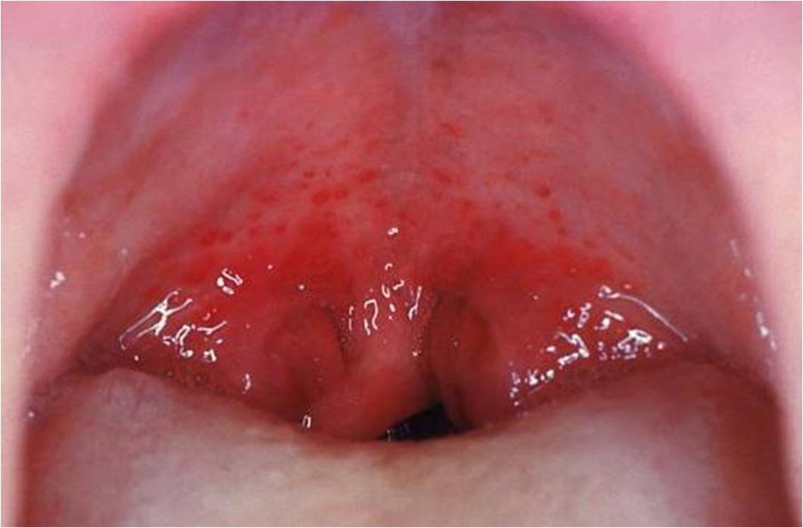 Pharyngite à streptocoques (@ CDC/Dr. Heinz F. Eichenwald, Wikimedia).