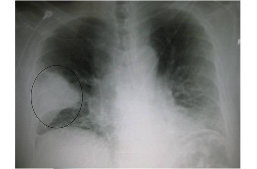 Radiographie du thorax montrant une pneumonie franche lobaire aiguë en forme de coin dans le poumon droit (photo @ Wikimédia).