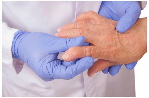 Examen d'une main affectée de polyarthrite rhumatoïde.