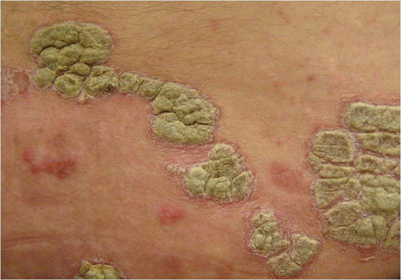 Psoriasis pustuleux (@ James Heilman, MD, Wikimedia)